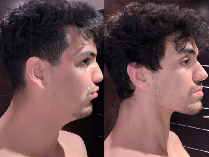 Mewing effect on lips in before and after picture